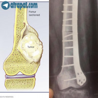 عمل تومورال،تعويض ديستال استخوان فمور،استفاده از الو گرفت