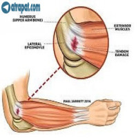 درمان درد آرنج يا تنیس بازان یا tennis elbow
آرنج تنیس بازان در واقع التهاب محل اتصال عضلات ساعد به انتهای استخوان بازو می باشد.این بیماری یکی از شایعترین آسیب های ورزشی می باشد . (شکل ۱) بیمار اغلب از درد قسمت خارجی آرنج شکایت دارد.درمان شامل تزریق داروی ضد التهاب وانجام تمرینات ورزشی اختصاصی این بیماری است 
تمرین اول

یک وزنه سبک(دمبل ۱ تا ۲ کیلو)را در دست بگیرید ودرحالی که مچ دست صاف است ؛ آرنج را خم کنید و اندام را در این وضعیت نگه دارید(به مدت ۵ ثانیه) و به آهستگی آرنج را صاف کنید.این حرکت را ۱۰ بار انجام دهید .روزانه ۵ تا ۱۰ بار تمرین فوق را طبق شکل انجام دهید.(شکل۲)

شکل2

تمرین ۲

یک حوله را طبق شکل با دستان خود بگیرید و طبق شکل؛در دو جهت مخالف بپیچانید(شبیه حالت چلاندن پارچه!)این نرمش را 10 بار تکرار کنید وروزانه 5بار تمرین فوق را انجام دهید.(شکل 3)

شکل3

تمرین ۳

در حالی که آرنج صاف است با دست مقابل دست مبتلا را به پشت خم کنید و این وضعیت را به مدت 15 ثانیه حفظ کنید.این نرمش را 5 بار تکرار کنید.روزانه 5 تا 7 ست از این نرمش را انجام دهید(شکل4). تمرین ۴:

در حالی که آرنج صاف است با استفاده از دست مقابل دست را از مچ خم کنید این وضعیت را به مدت 15 ثانیه حفظ کنید.این نرمش را 5 بار تکرار کنید.روزانه 5 تا 7 ست از این نرمش را انجام دهید(شکل۵).