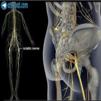 #سوال_یکی_از_بیماران

سیاتیک چیست؟

عصب سیاتیک  از جمله بزرگترین و طولانی ترین عصب ها در بین اعصاب  بدن می باشد  که در عین حال درگیری ان  می تواند برای بیماربسیار درد سرساز هم باشد.  عصب سياتيك که از ناحیه تحتانی ستون مهره ها و از مجاورت #دیسک های پایینی #کمر منشا گرفته و به سمت استخوان لگن و با سن امتداد می یابد و سپس از پشت ران وارد ساق پا می شود. 
عصب #سیاتیک  وقتی درگیر می شود ممکن است هر نقطه ای از عصب درد را نشان دهد در شرایطی که بقیه قسمت ها فاقد درد باشد. با توجه به اینکه رگ سیاتیک در پشت ساق پا به دو شاخه تقسیم می شود، یکی از پشت ساق پا به کف پا می رود ودیگری از کناره خارجی ساق و روی مچ پا می گذرد ، بنابراین ممکن است فردی دارای درد تنها در قسمت خارجی ساق پا و بدون کمر درد باشد اما علت ، درد سیاتیکی است.