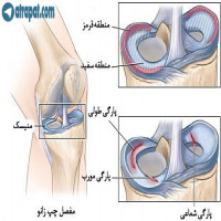 #سوال_یکی_از_بیماران ❓⁉️پارگى منيسك چيست وچه درمانهايى لازم دارد. 